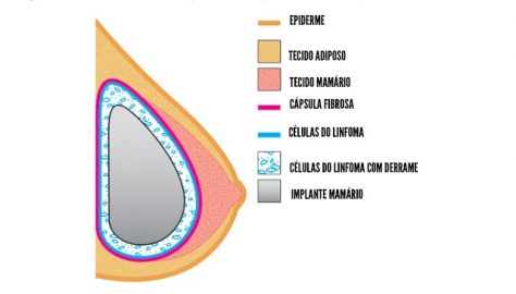 Linfoma e implantes