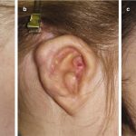 Malformações do ouvido externo: consequências no sistema auditivo