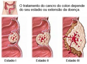 rp_estadiamento-cancro-colon-300x221.jpg