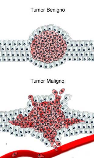 Diferenca-Tumor-Maligno-e-Benigno_Vertical